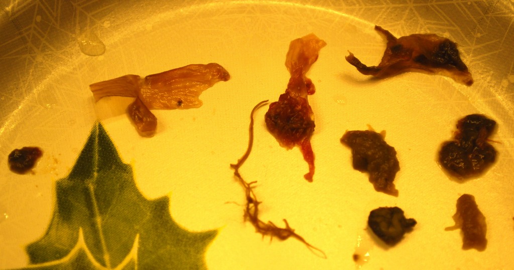 These were found in the stool of a young woman seriously infested with parasites.